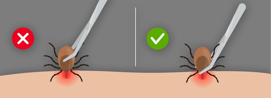 Ticks are taking over in Virginia. Could ODU's 'tick robot' help? 5 An illustration of how to properly remove a tick embedded in a person's skin.